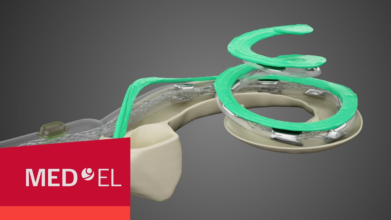 Electrodos de implante coclear para cada cóclea