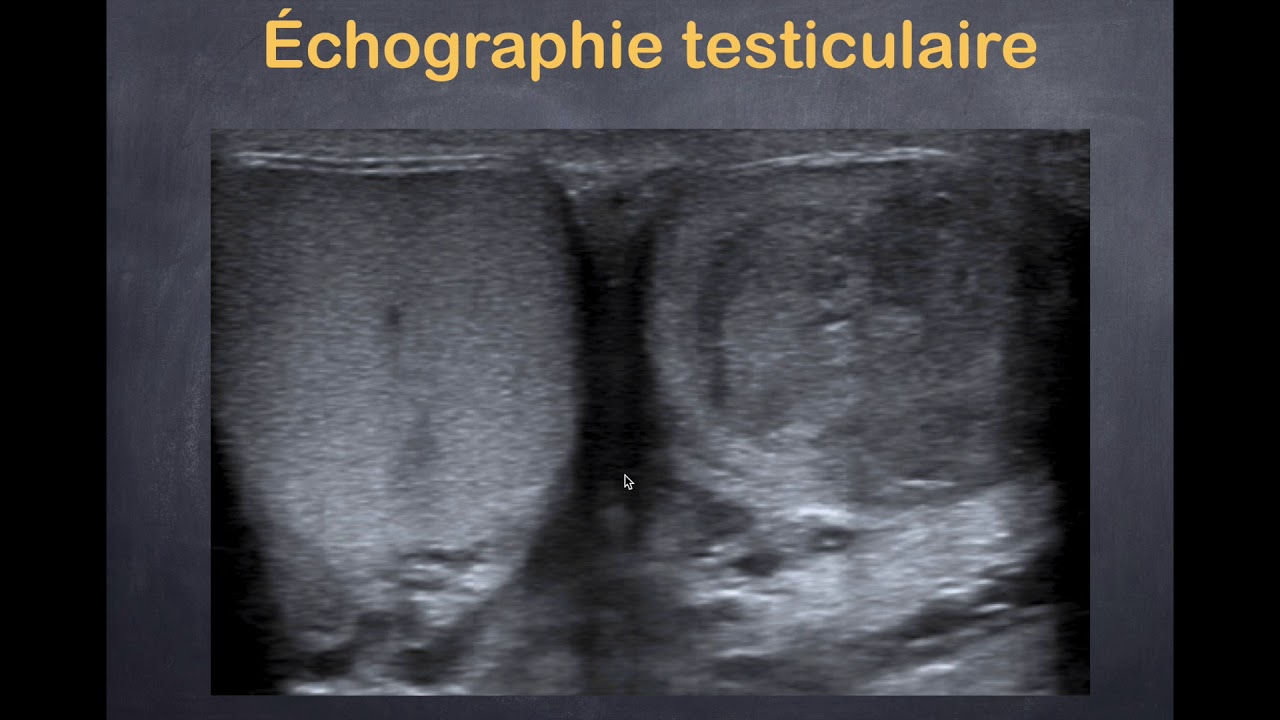 Tumeurs du testicule - 2. Imagerie pathologique