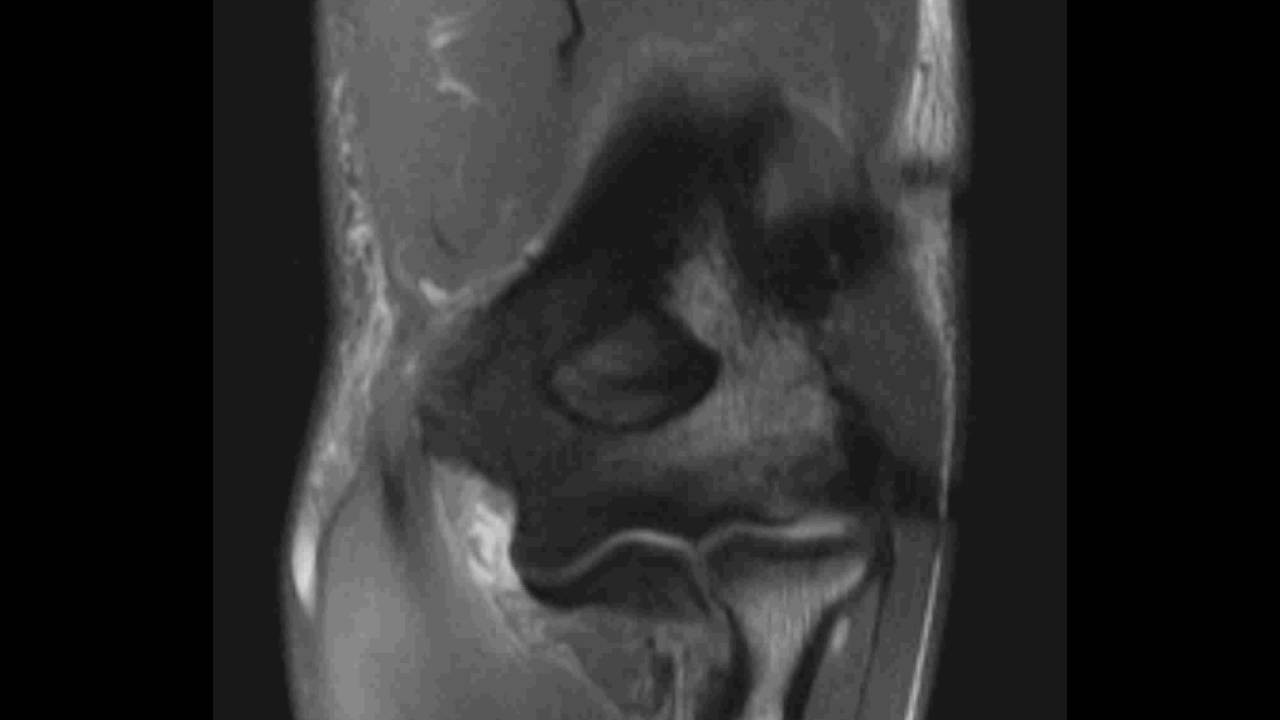 Poor fat suppression elbow