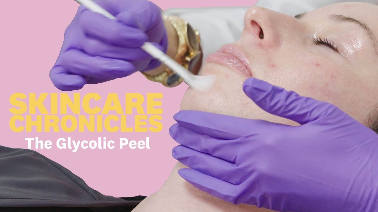 Should You Get a Chemical Peel for Acne? | Skincare Chronicles | Women's Health