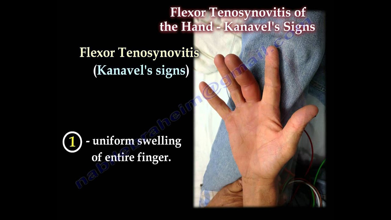 Flexor Tenosynovitis Of The Hand Kanavel's Signs - Everything You Need To Know - Dr. Nabil Ebraheim