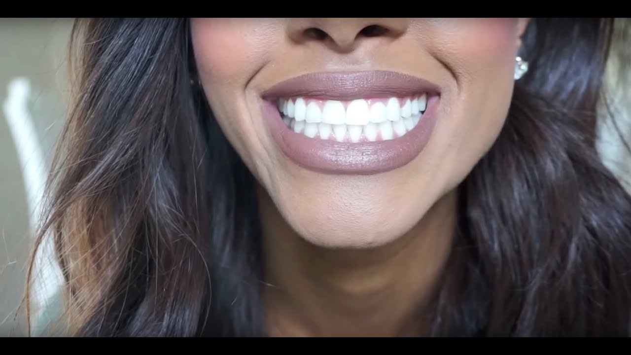 Life After Adult Braces, Dental Implants, & Veneers - Q&A | Mariah Navit