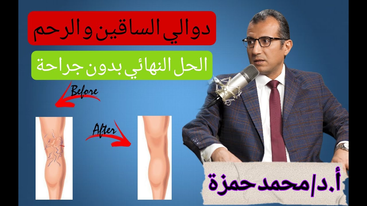 دوالي الرحم و الساقين ( الأسباب - الأعراض - العلاج ) الحل النهائي بدون جراحة | بودكاست مع البروفيسور