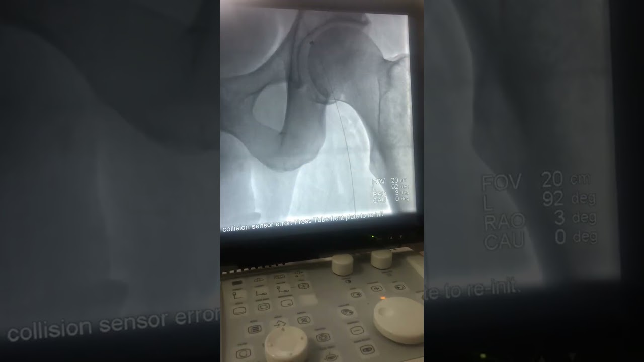 Periferik arter hastalığı olan hastamızı sağlığına kavuşturduk.