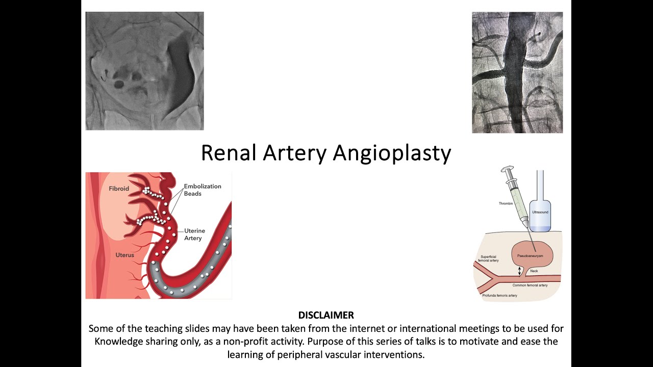 2. Renal Artery Angioplasty