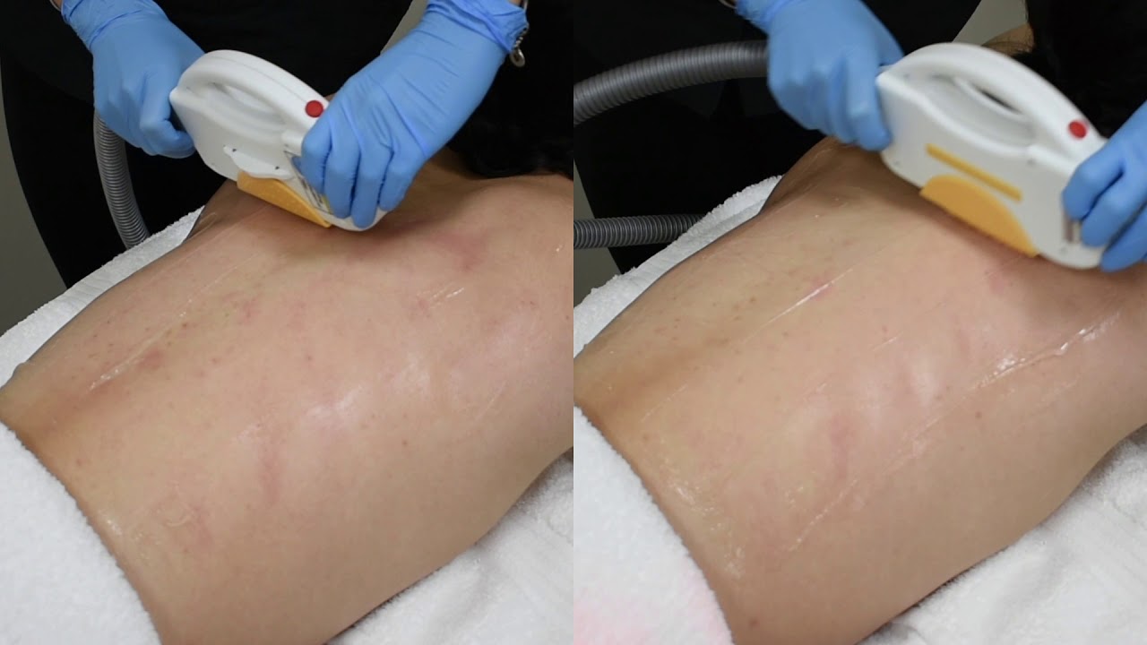 The Global Beauty Group 3 Business Benefits - IPL vs SHR (Male Hair Removal)