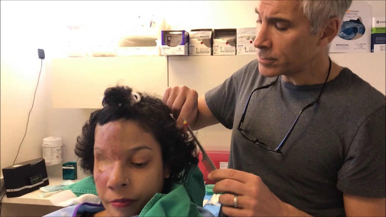 Pro Bono Hair Procedure as Performed by Dr. Epstein