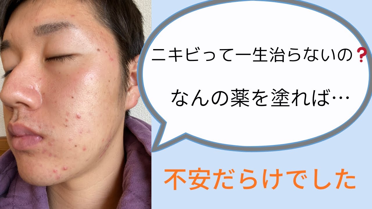 ニキビが酷かった頃の本音。あの時、毎日つらかった