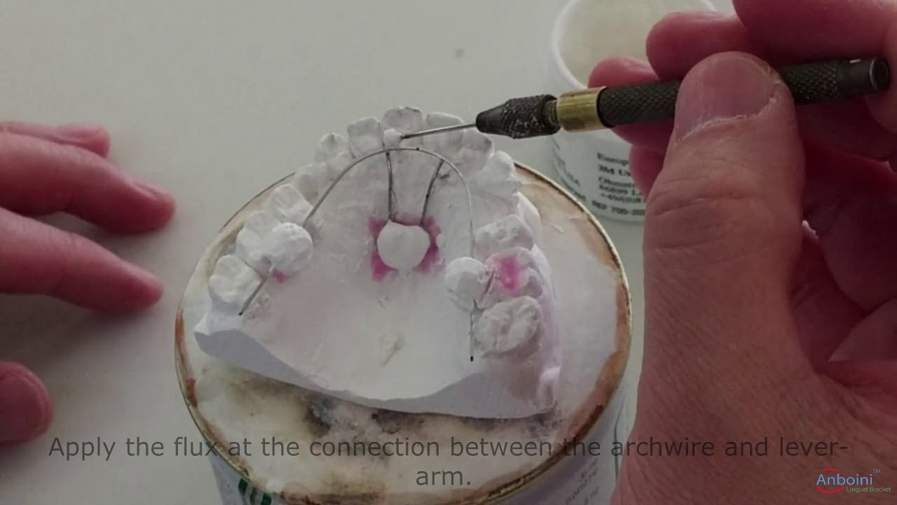 Soldering of Lever-Arm to Lingual Archwire: Anboini Lingual Orthodontic System Clinical Guide