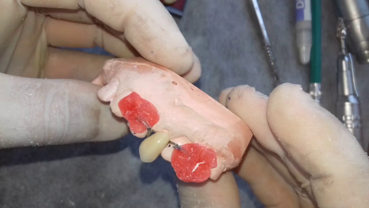 Confecção de PPR provisória a frio. PARTE II - Preparo de dentes