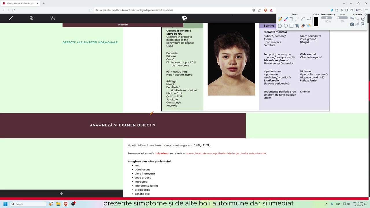 2.06  - KUMAR -  Endocrinologie - Hipo si Hipertiroidismul, Oftalmopatia Graves, Cancerul Tiroidian