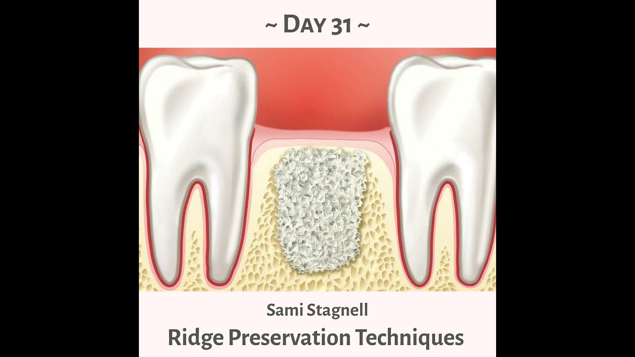 90 Day Dental Day 31- Sami Stagnall- Ridge Preservation Techniques