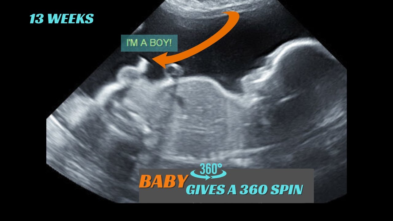 13 weeks | Baby boy | does 360 spin in womb | Ultrasound