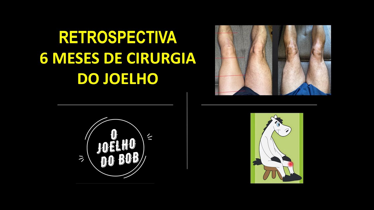 6 meses de cirurgia do joelho (Retrospectiva da reabilitação após reconstrução do LCA). (#17).