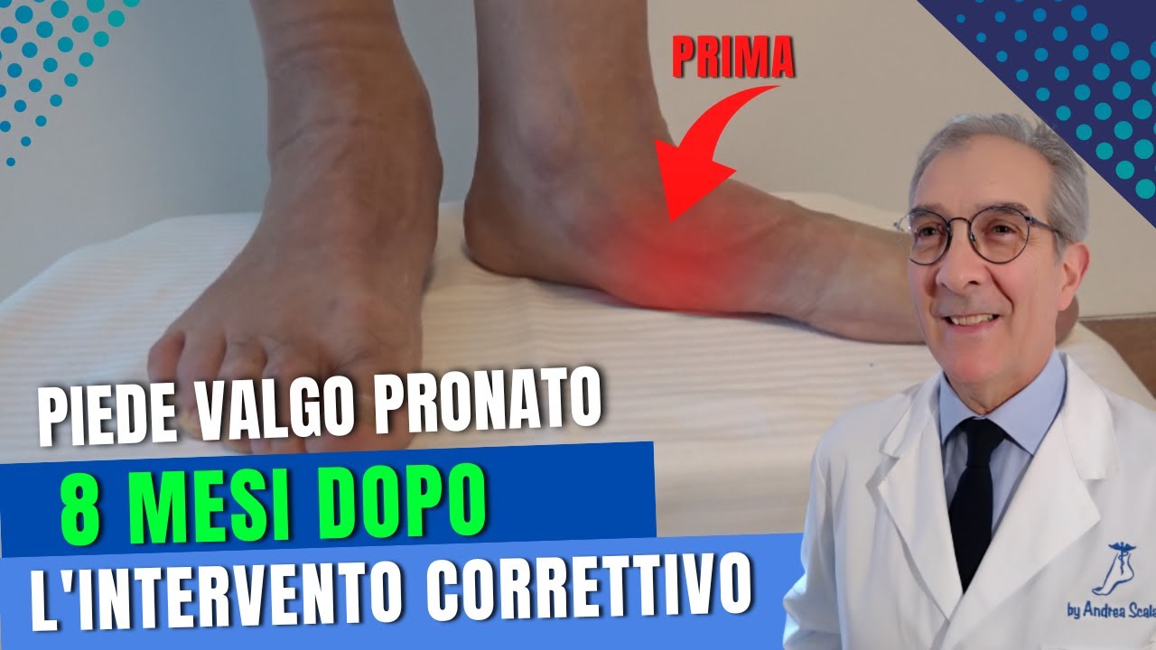 PIEDE VALGO PRONATO 8 MESI DOPO L' INTERVENTO | Dott. Andrea Scala