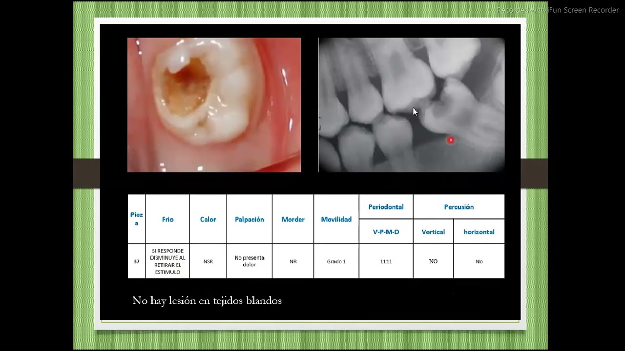 ENDODONCIA - TIPOS DE DIAGNOSTICO PULPAR Prt2