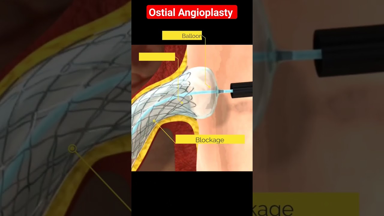 Angioplasty (Animation) l Ostial Stenting l RCA l #angioplasty #shorts
