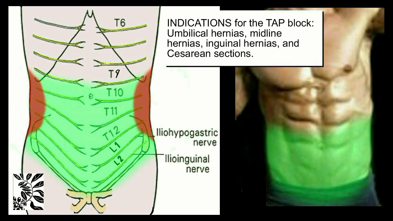The Ultrasound-Guided TAP Block