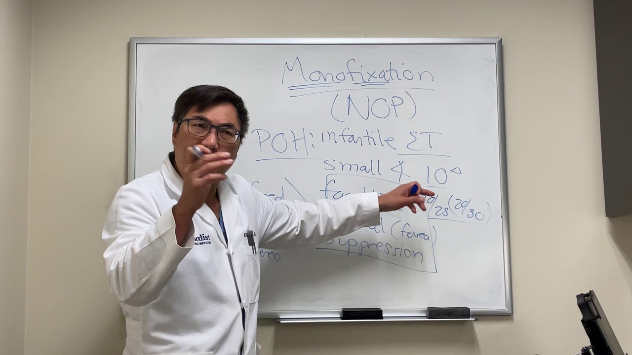 Monofixation syndrome in neuro ophthalmology