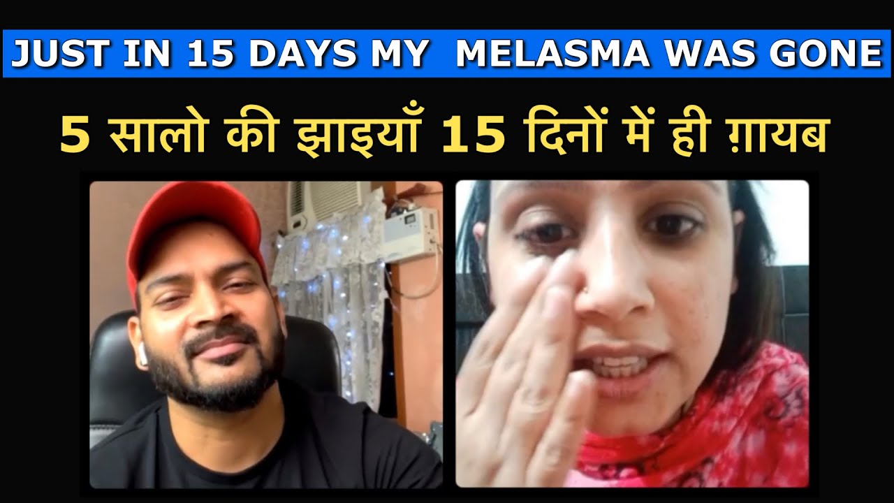 Just in 15 days my 5 years old Melasma was gone. 5 सालो की झाइयाँ 15 दिनों में ही ग़ायब