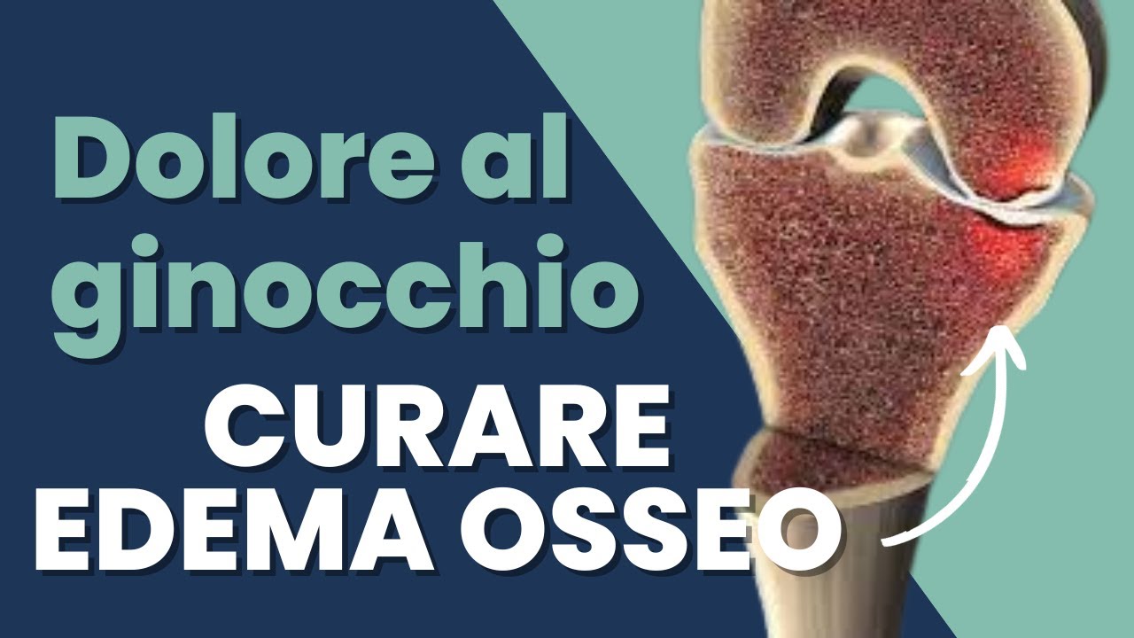 Edema osseo ginocchio come si cura - Una causa speciale di dolore al ginocchio