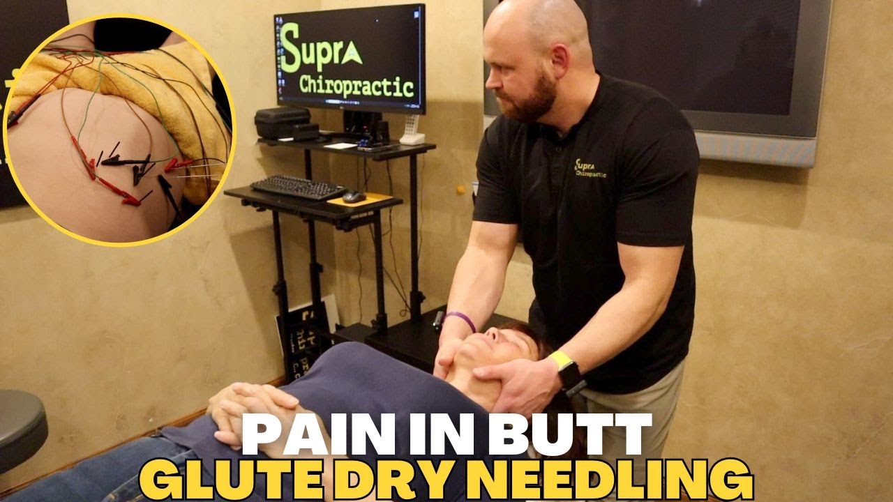 Dry Needling For The Gluteal Muscles *TIGHT CRACKS*
