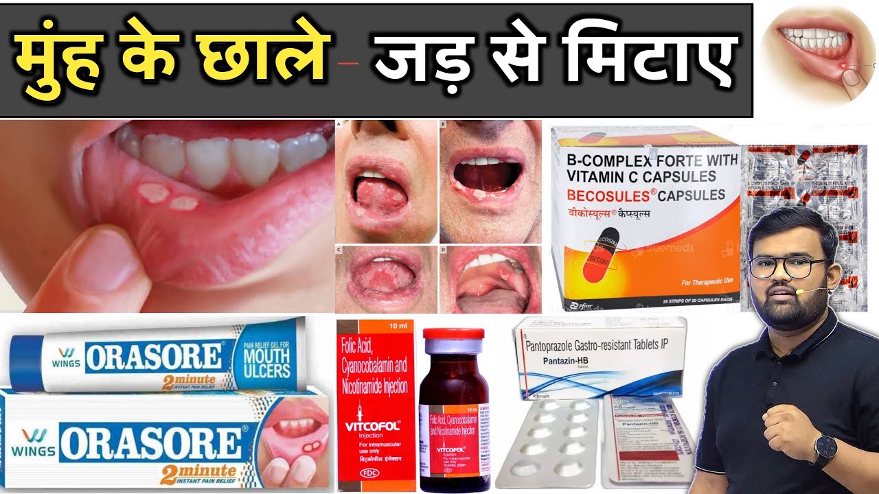 मुंह के छाले | Medicine | Mouth Ulcer | Ulcer Medicine | Pharmacy | Treatment | Doctor | MBBS