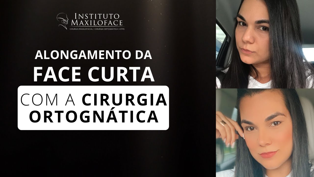 Alongamento da face curta com a cirurgia ortognática | Instituto Maxiloface