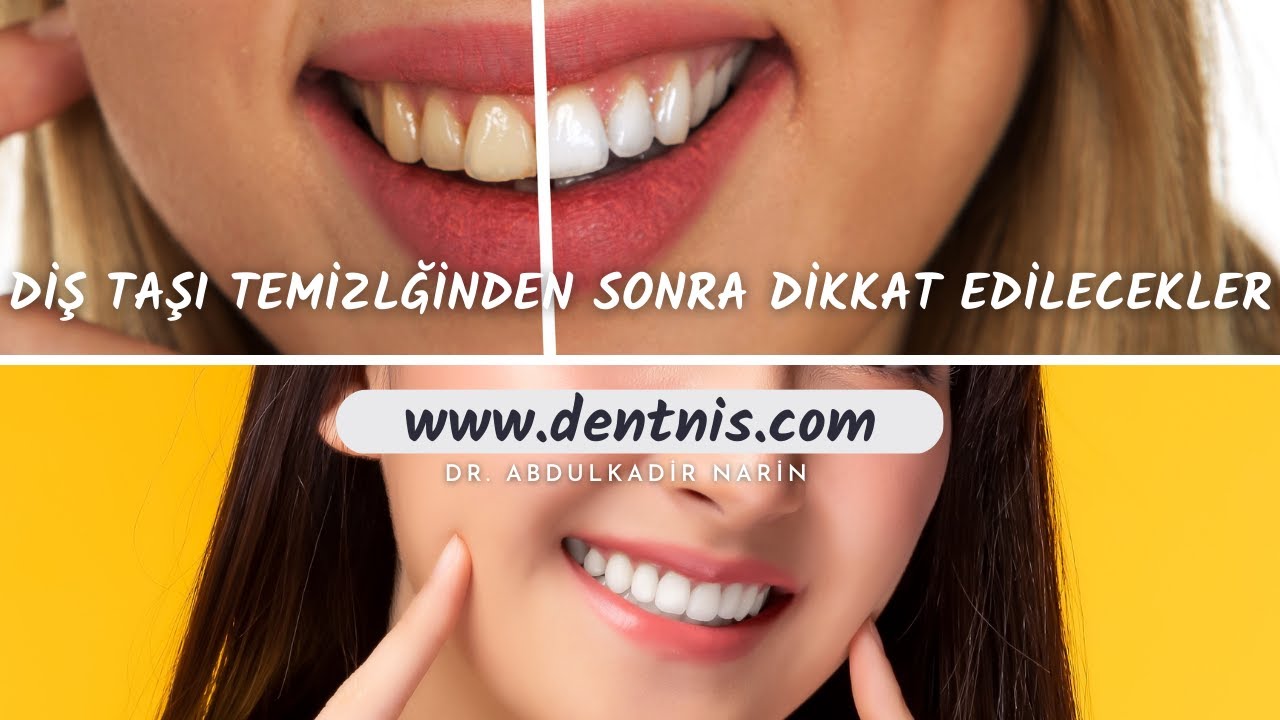 Diş Taşı Temizliğinden Sonra Nelere Dikkat Etmeliyiz?