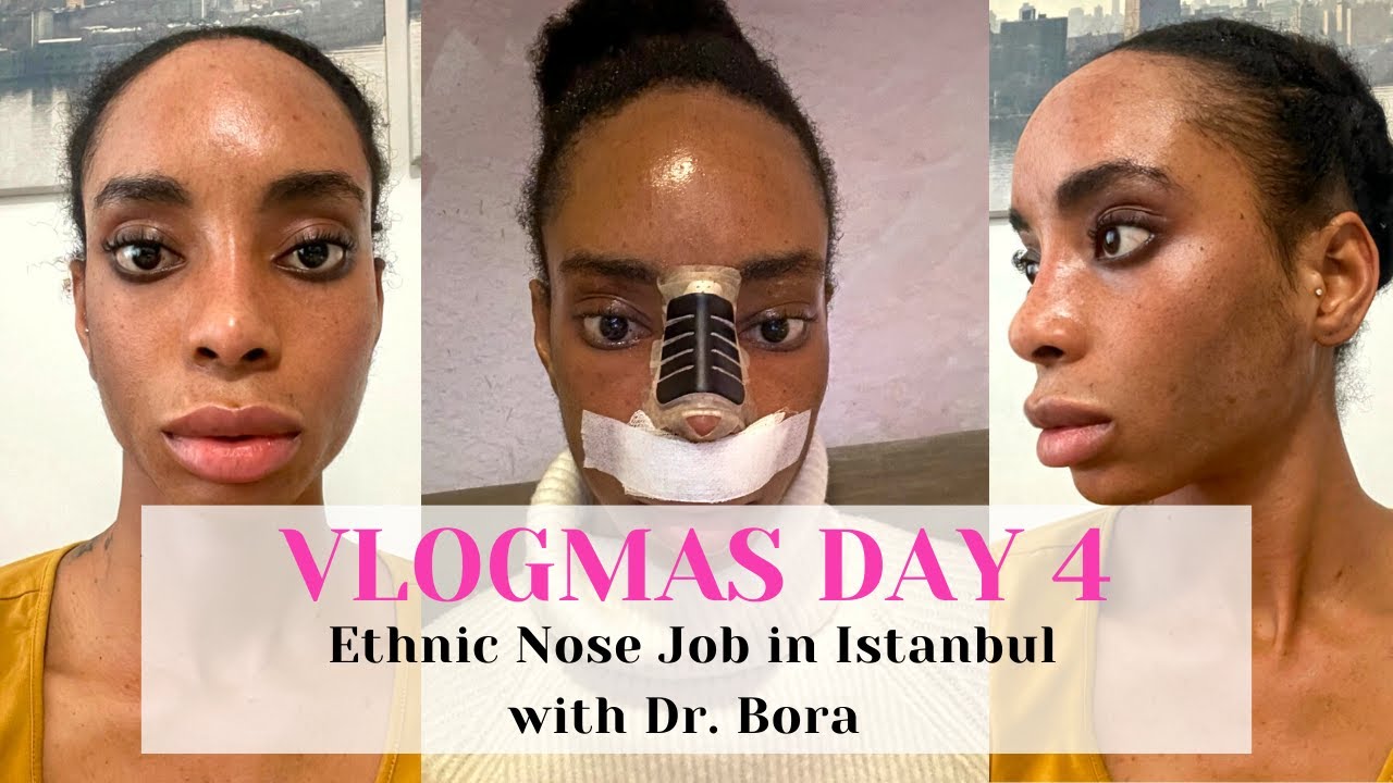 NOSE JOB IN ISTANBUL WITH DR. BORA: VLOGMAS DAY 4 | CONSULTATION DAY, CLINIC REVIEW & HOTEL MOVE