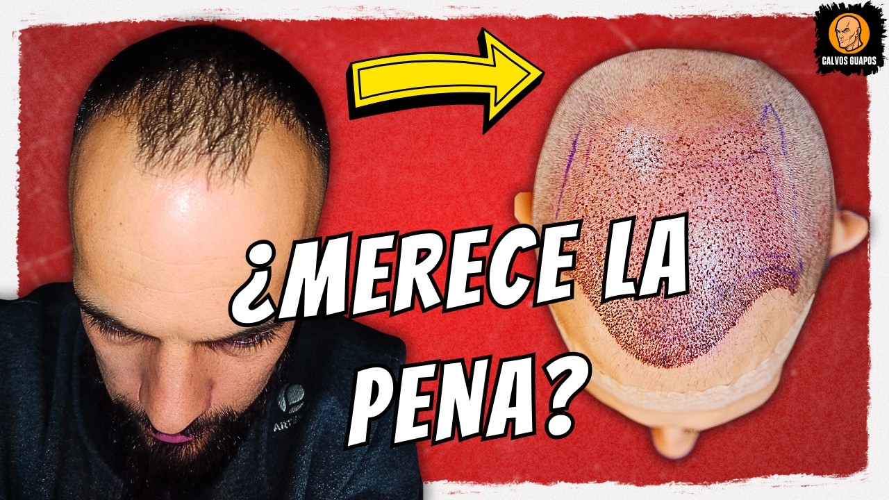 🥝 Mi EXPERIENCIA en una de las MEJORES CLÍNICAS DE INJERTOS CAPILARES de MADRID