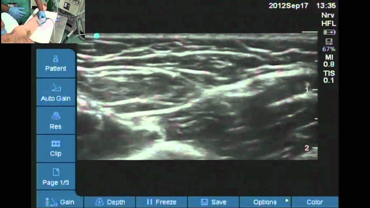 How to find nerves for axillary block