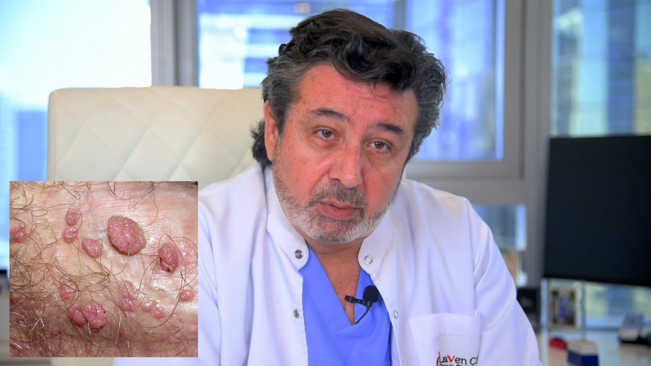 أفضل علاج للثآليل بالليزر في عيادة لافين