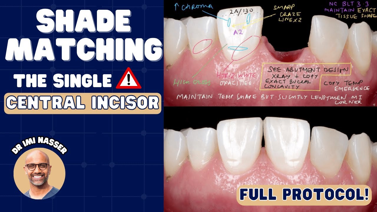 How to Shade Match the Single Central Incisor - PDP165
