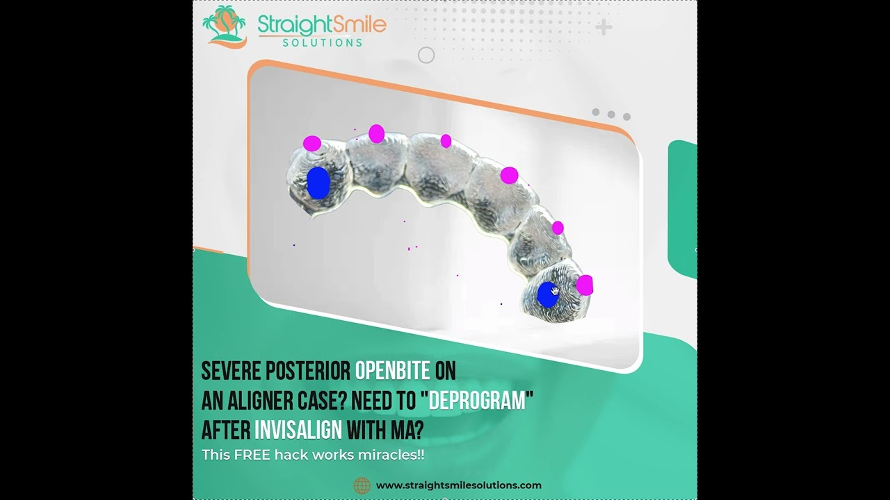 Deprogramming Settling Invisalign with MA Cases or Posterior Openbite Cases with CR-CO Shift