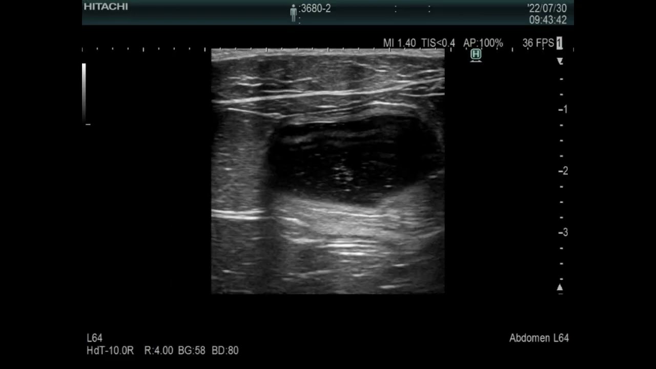 Urolithiasis,  Pocket size vs Stationary high-end system、eho images、cat(4kg)（ 猫の尿石症のポケットエコー）