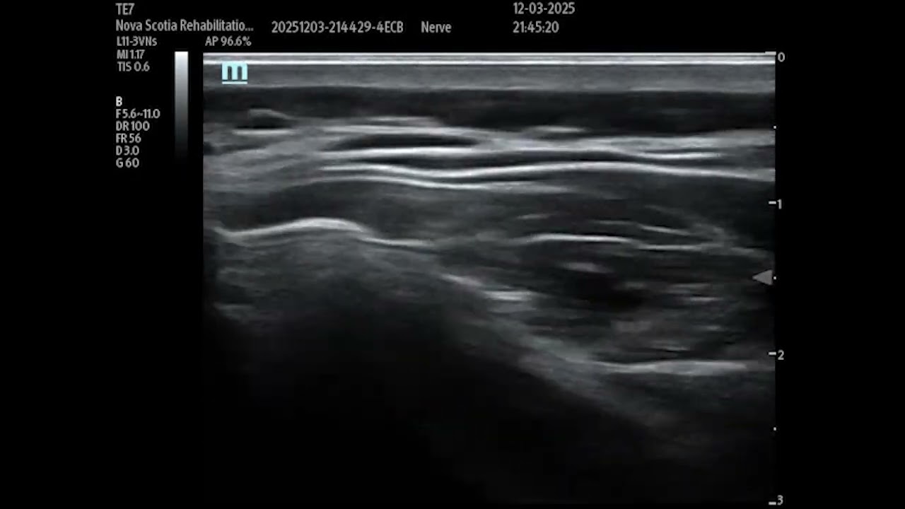 Ultrasound guided greater occipital nerve block