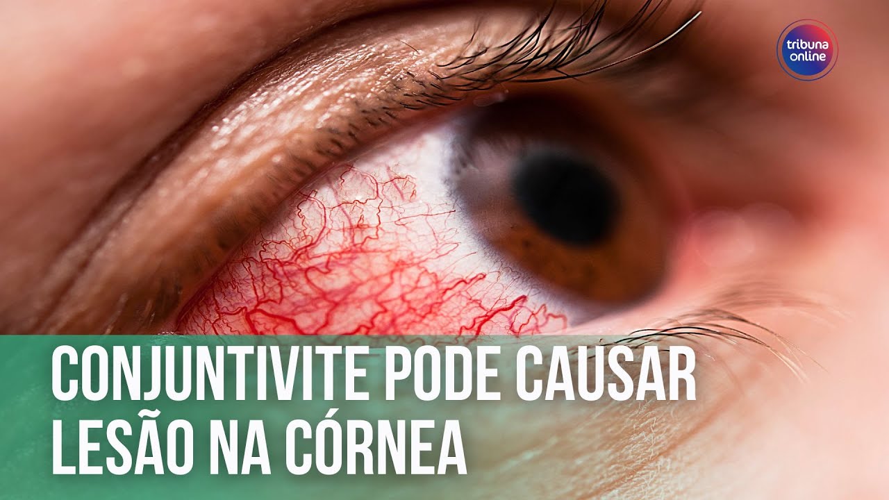 Conjuntivite pode causar lesão na córnea | Fala, Doutor!