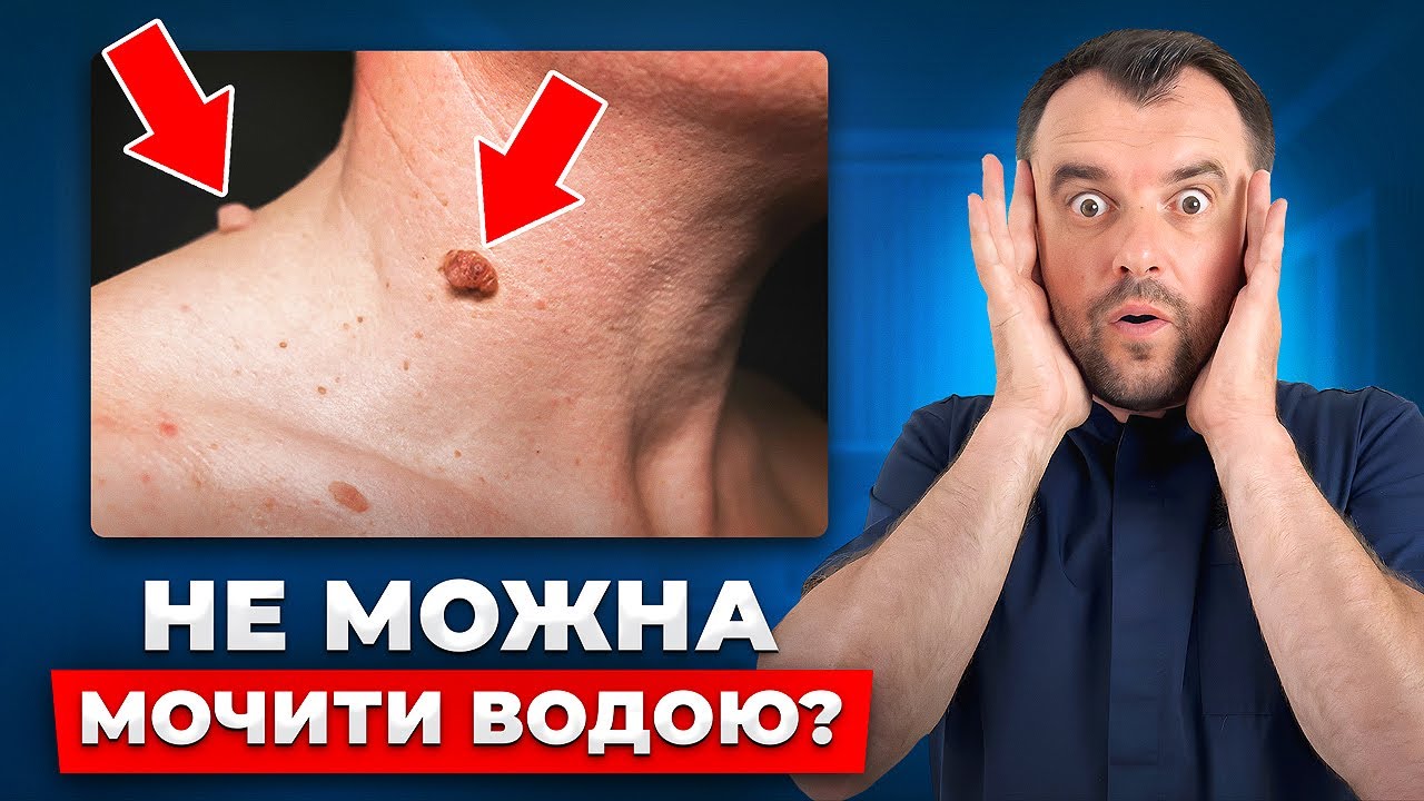 Це небезпечніше ніж ви думали. Правильне лікування папілом БЕЗ ОПЕРАЦІЙ