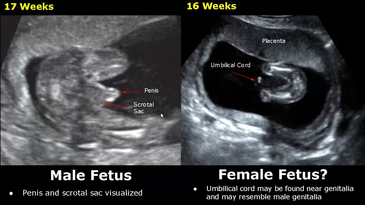Geslachtsbepaling van de foetus met echografie | Het geslacht van een baby bepalen met echografie (jongen/meisje)