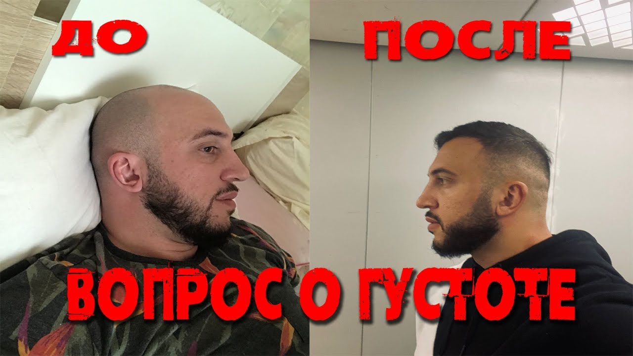 Пересадка волос в Москве.           Вопрос о густоте пересаженных волос.
