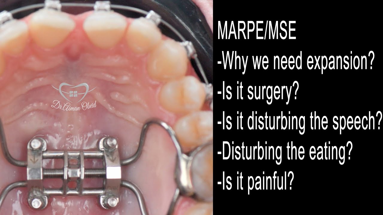 All Your MARPE/MSE Expansion Questions Answered! Pain, Eating & Speaking Concerns Addressed!
