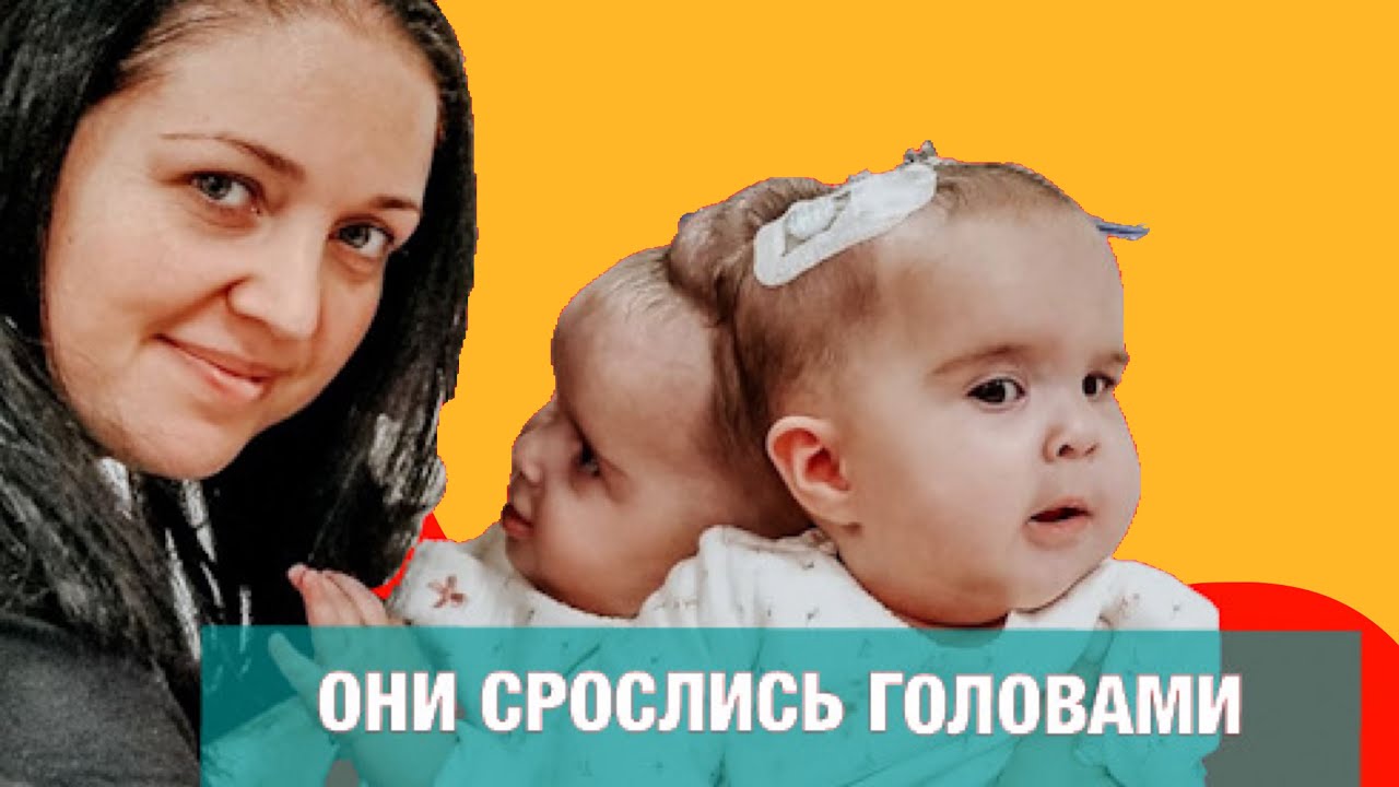 Сиамские близнецы Бачинские-Мирошник. МЫ С МУЖЕМ СРАЗУ РЕШИЛИ, АБОРТА НЕ БУДЕТ.