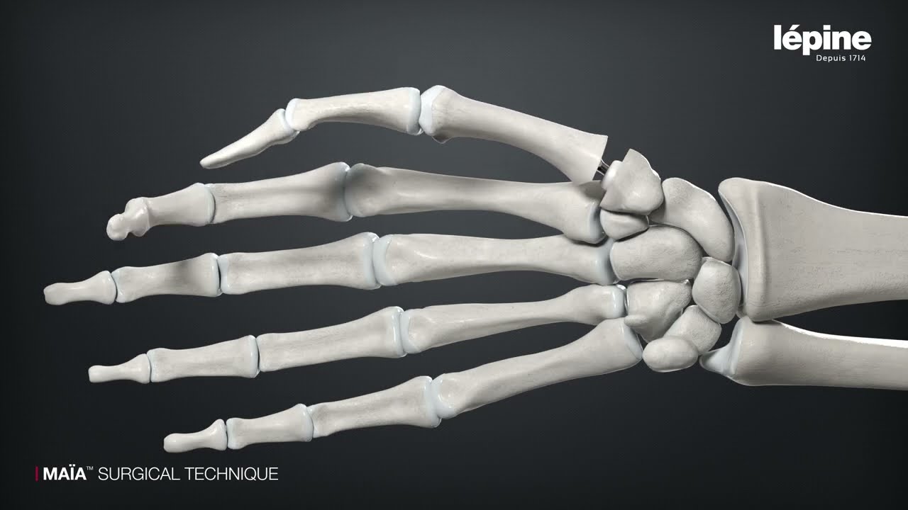 MA&Iuml;A&trade; Surgical Technique 3D Animation