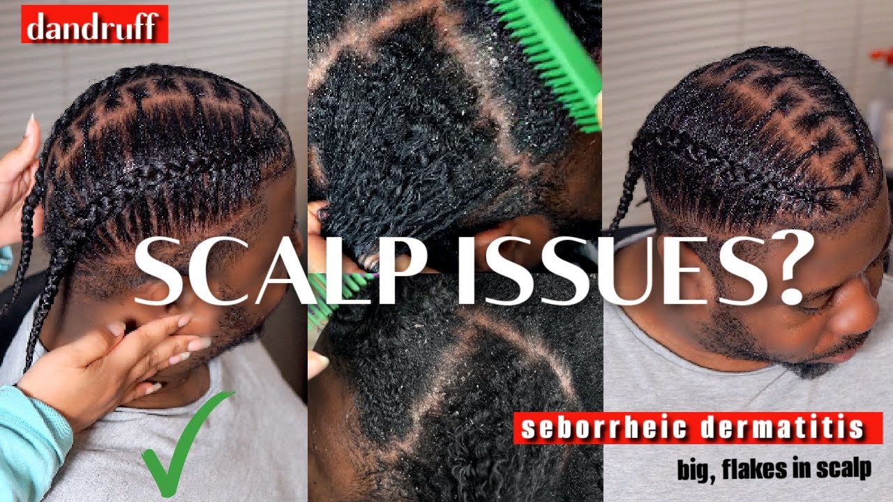 Dandurff? Dermatitis? Scalp Issues? 😲| Watch This! + Husband/Male Natural Hair Wash Day