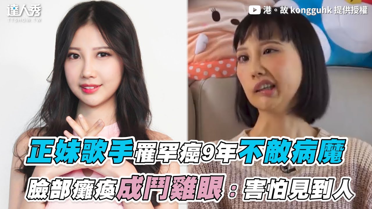 【正妹歌手罹罕癌9年不敵病魔 臉部癱瘓成鬥雞眼：害怕見到人】｜@kongguhk7942
