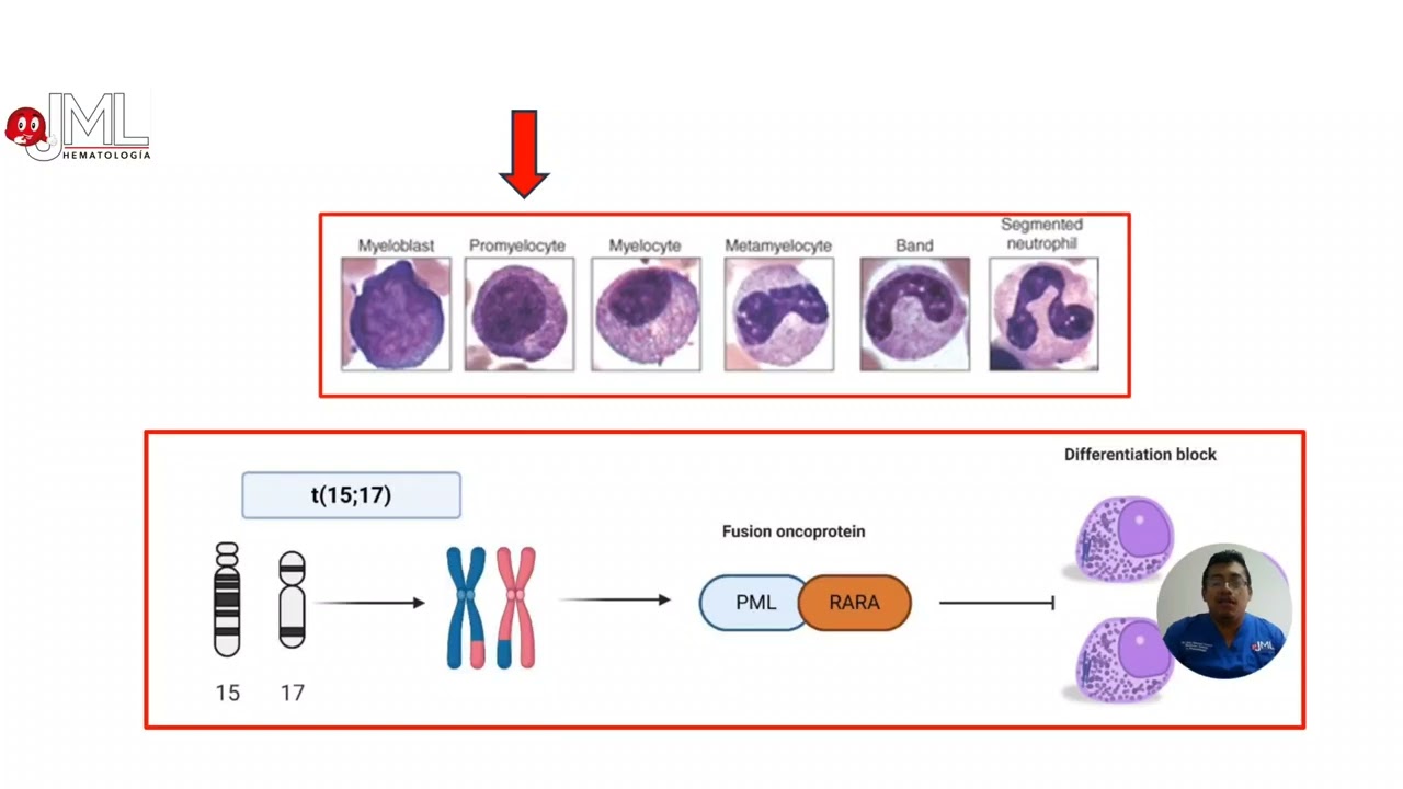 LEUCEMIA PROMIELOCÍTICA AGUDA (LPA). GENERALIDADES. FISIOPATOLOGÍA.
