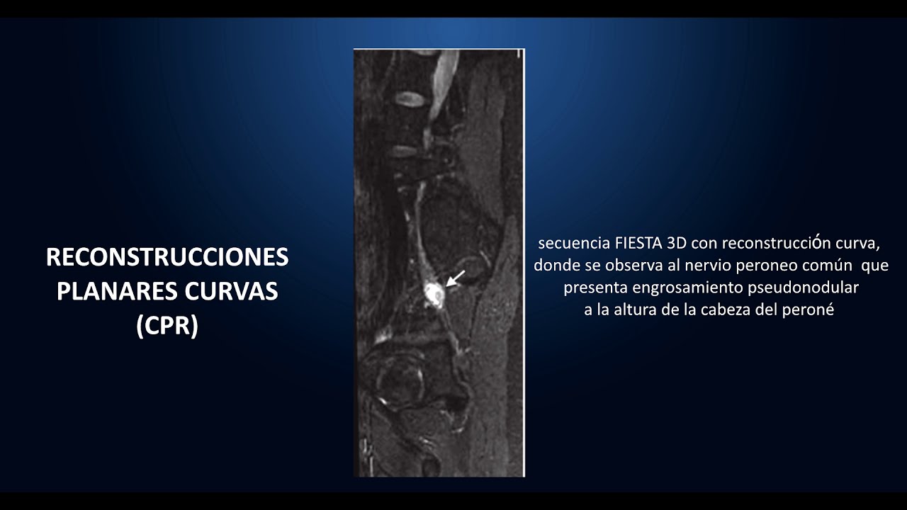 NEUROGRAFÍA DE LOS NERVIOS PERIFÉRICOS POR RESONANCIA MAGNÉTICA