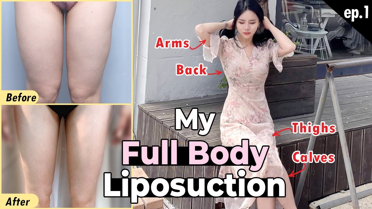 [SUB] My Full Body Liposuction Experience in Korean Clinic | Plastic Surgery Vlog with Before&After