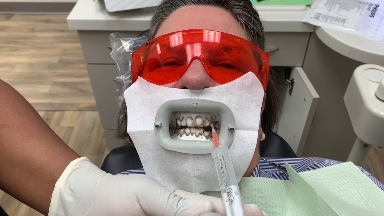 Houston Cosmetic Dentist... Watch this to see how Zoom whitening works! Step by Step:)